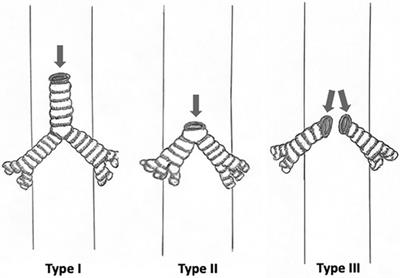 Tracheal agenesis: the importance of teamwork in an uncommon pathology, challenging diagnosis, and high mortality—a case report